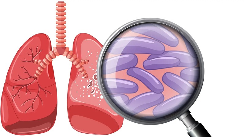 Pulmonary tuberculosis patients illustration